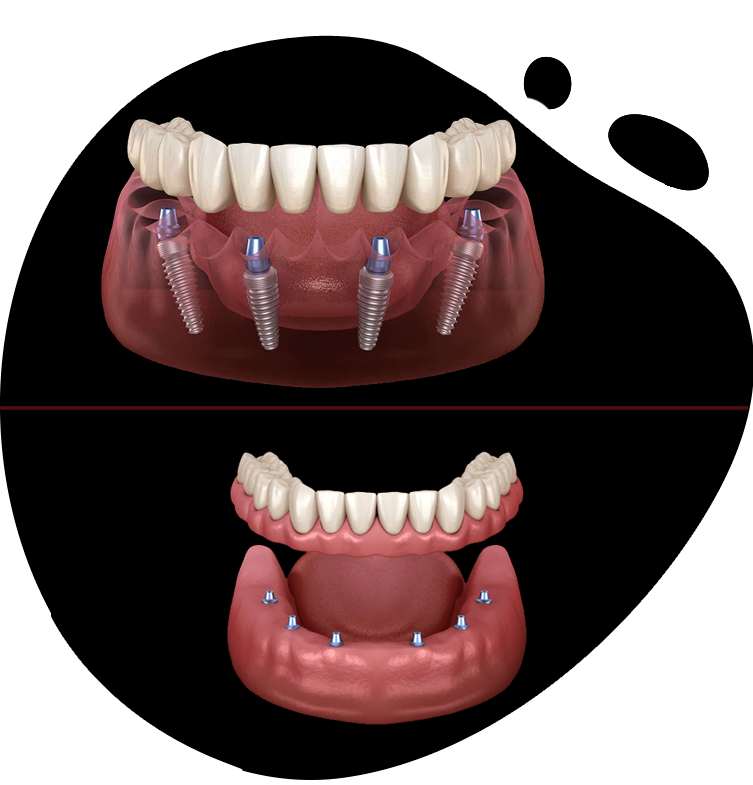 https://www.magizhchidental.in/wp-content/uploads/2021/02/dd-img-3.png