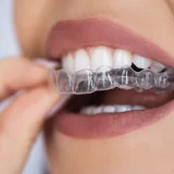 clear aligners