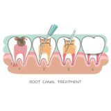 Root Canal Treatments - What to Expect