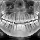 #XRays #Dental #Teeth